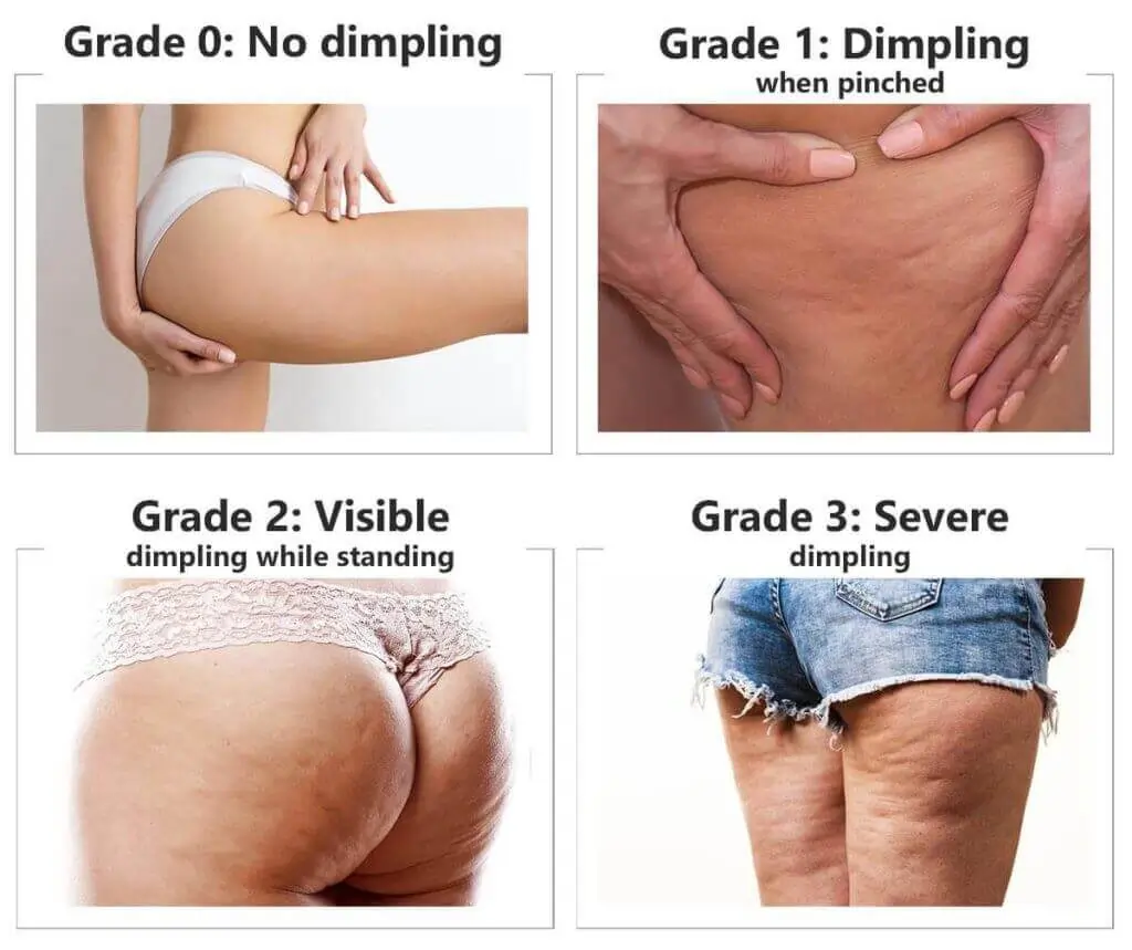 Representation of the stages of cellulite development Membury